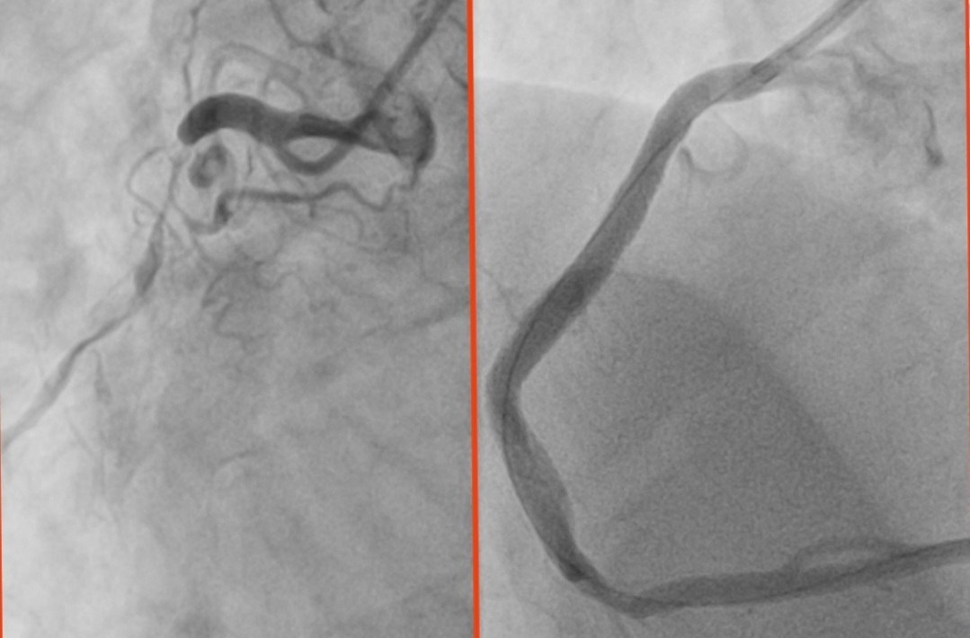 В саратовскую больницу поступил 32-летний пациент с «сердцем старика»